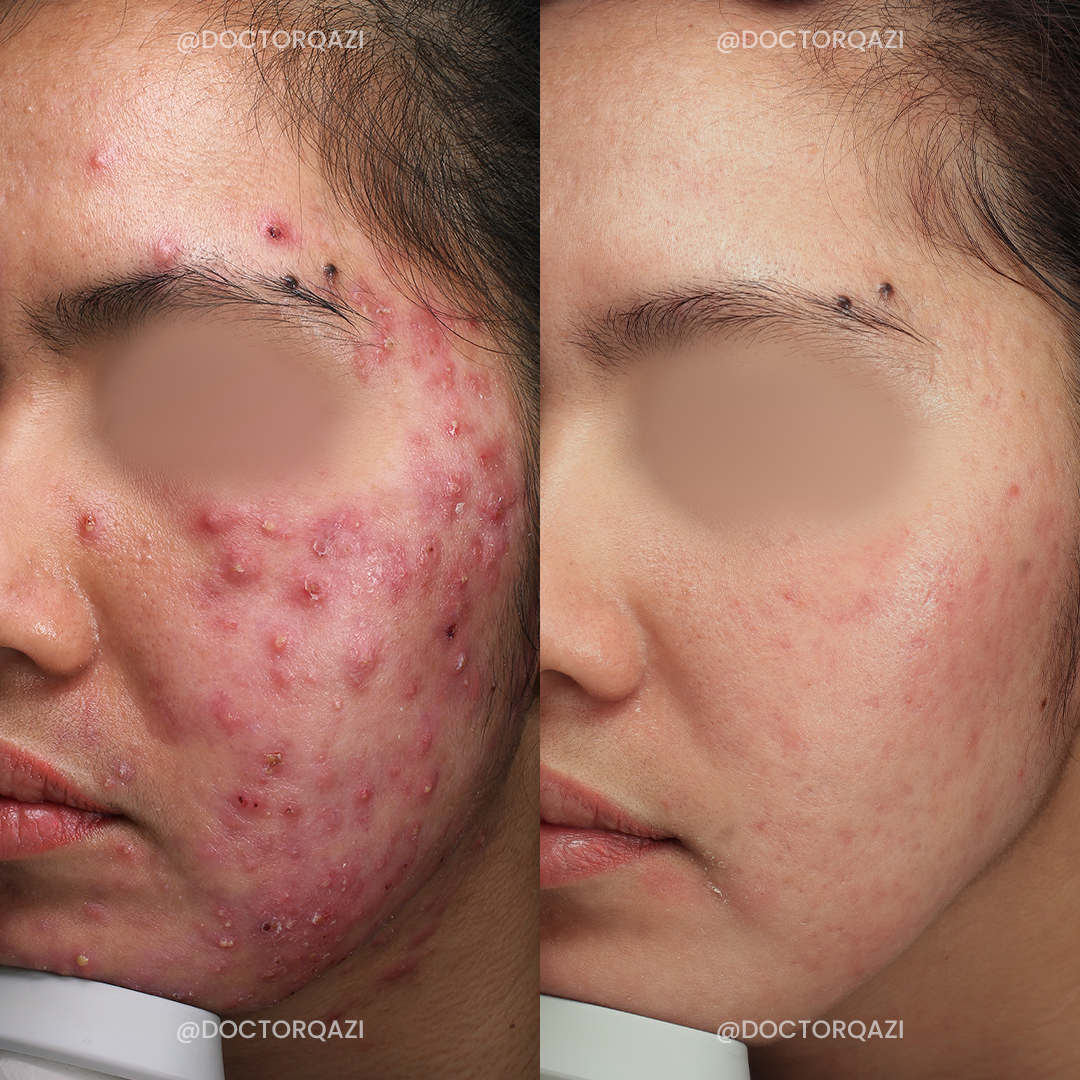 Accure Acne Laser Treatment (Student Discount)