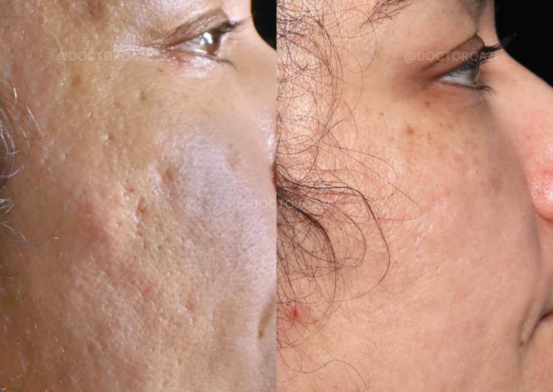 Acne Scar Consultation with Dr. Qazi (20 Minutes)