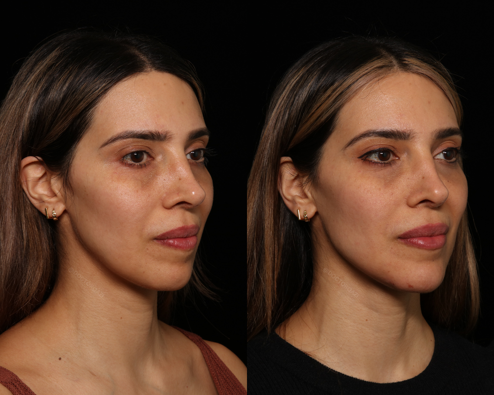 Chin Filler - Crystal Pricing