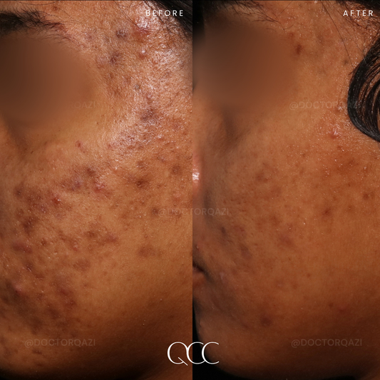 Hypopigmentation in Dark Skin