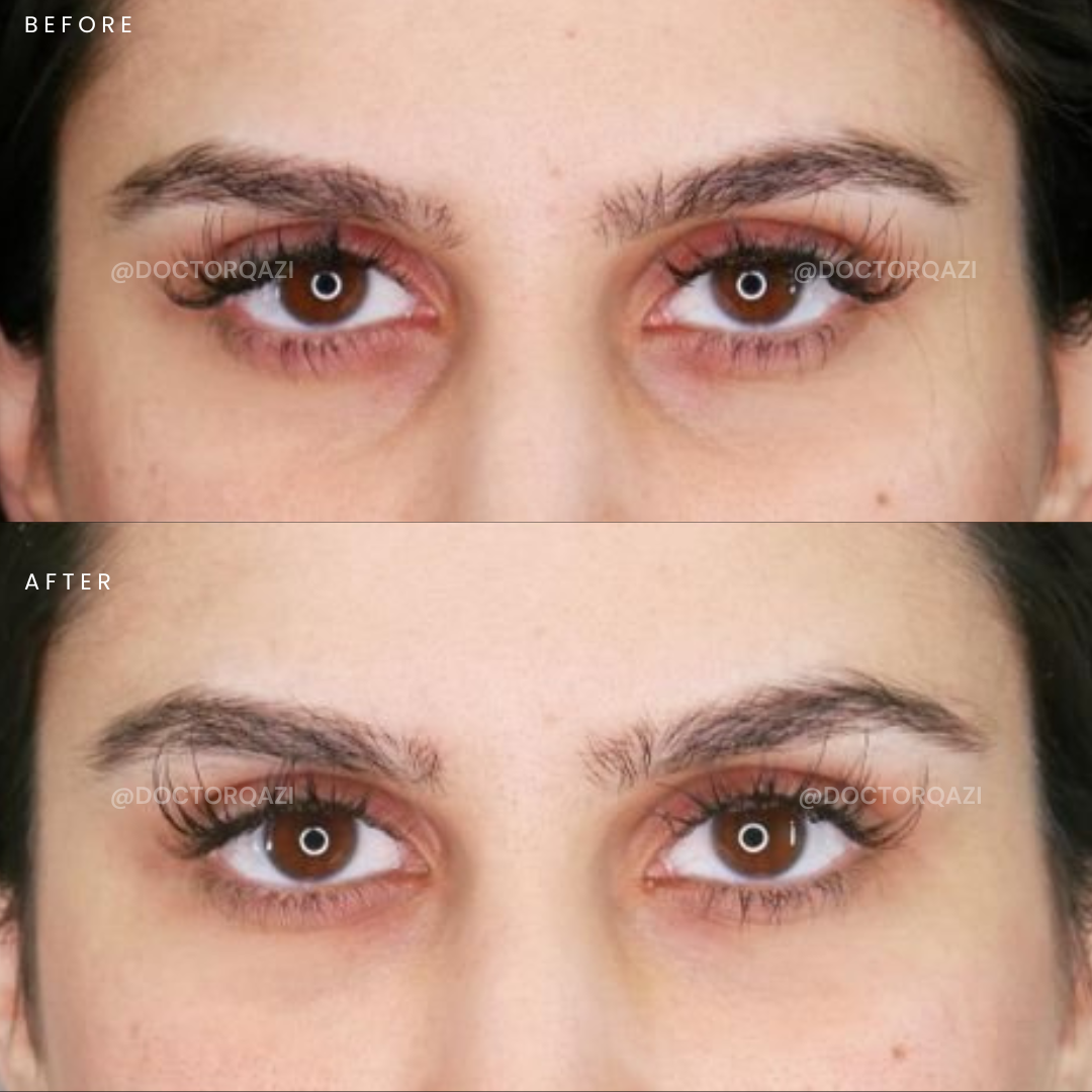 PRP Therapy for Undereye Dark Circles