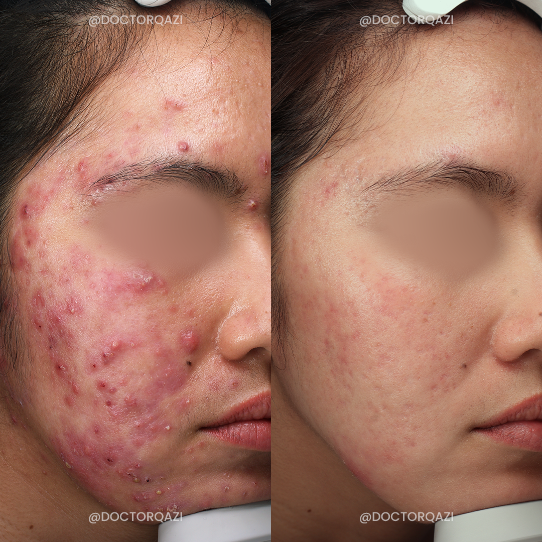 Accure Acne Laser Treatment