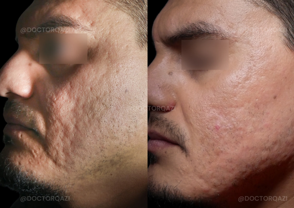 Acne Scar Consultation with Dr. Qazi (20 Minutes)