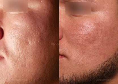 Acne Scar Consultation with Dr. Qazi (20 Minutes)