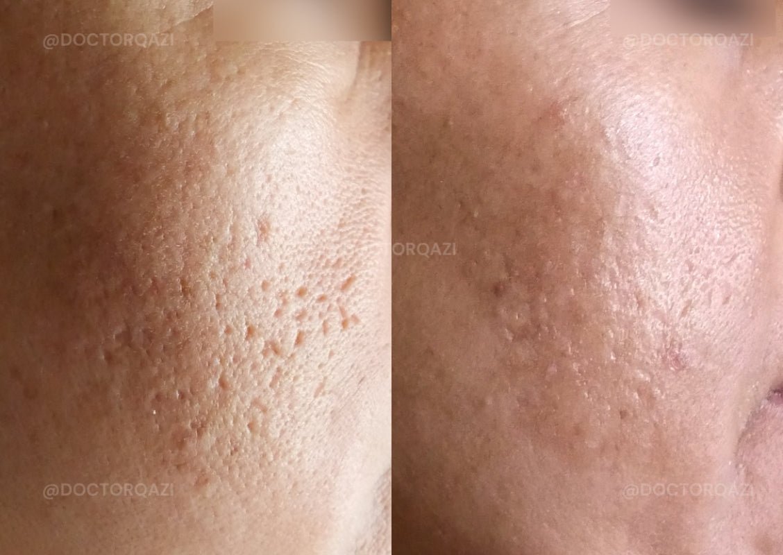 Acne Scar Consultation with Dr. Qazi (20 Minutes)