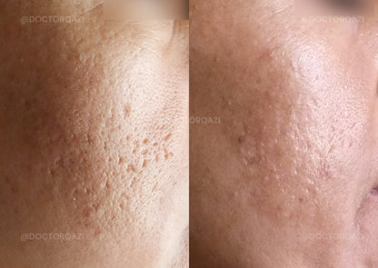 Acne Scar Consultation with Dr. Qazi (20 Minutes)