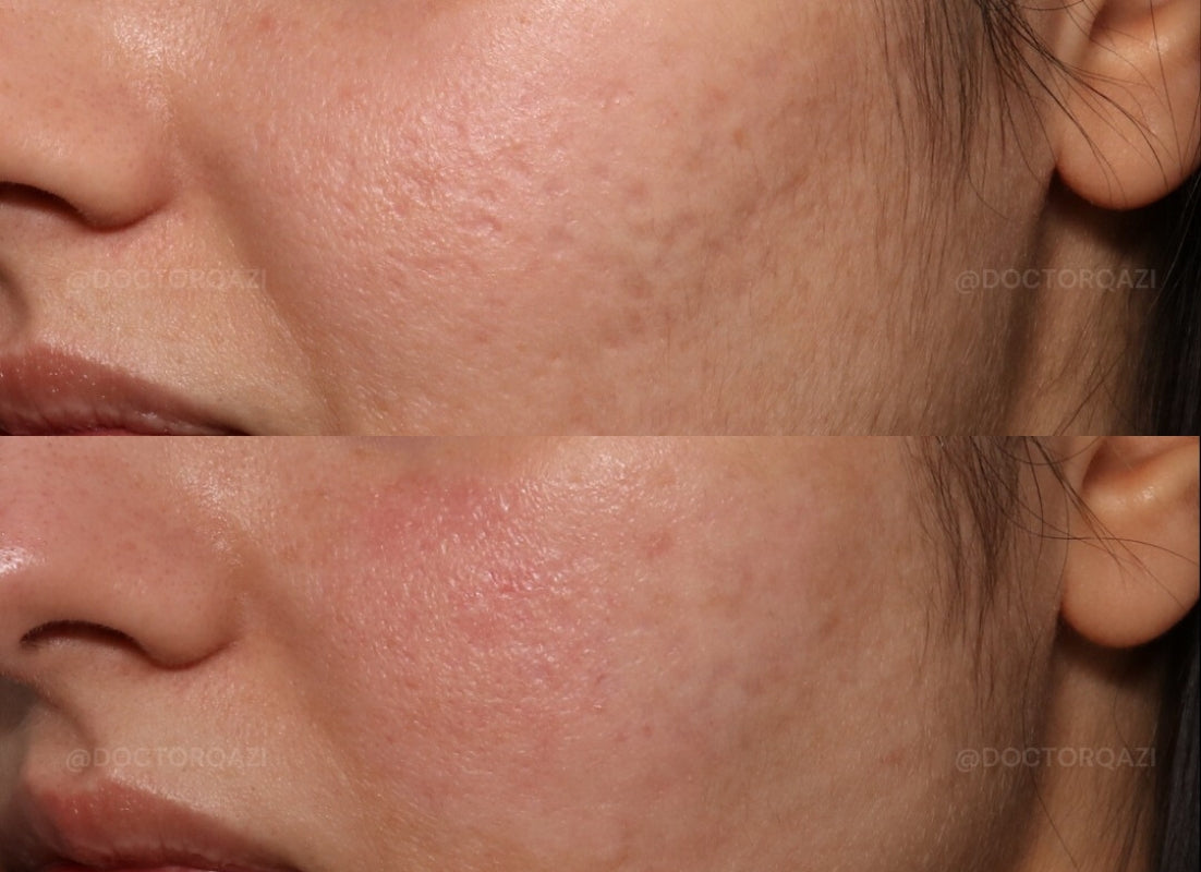 Acne Scar Consultation with Dr. Qazi (20 Minutes)
