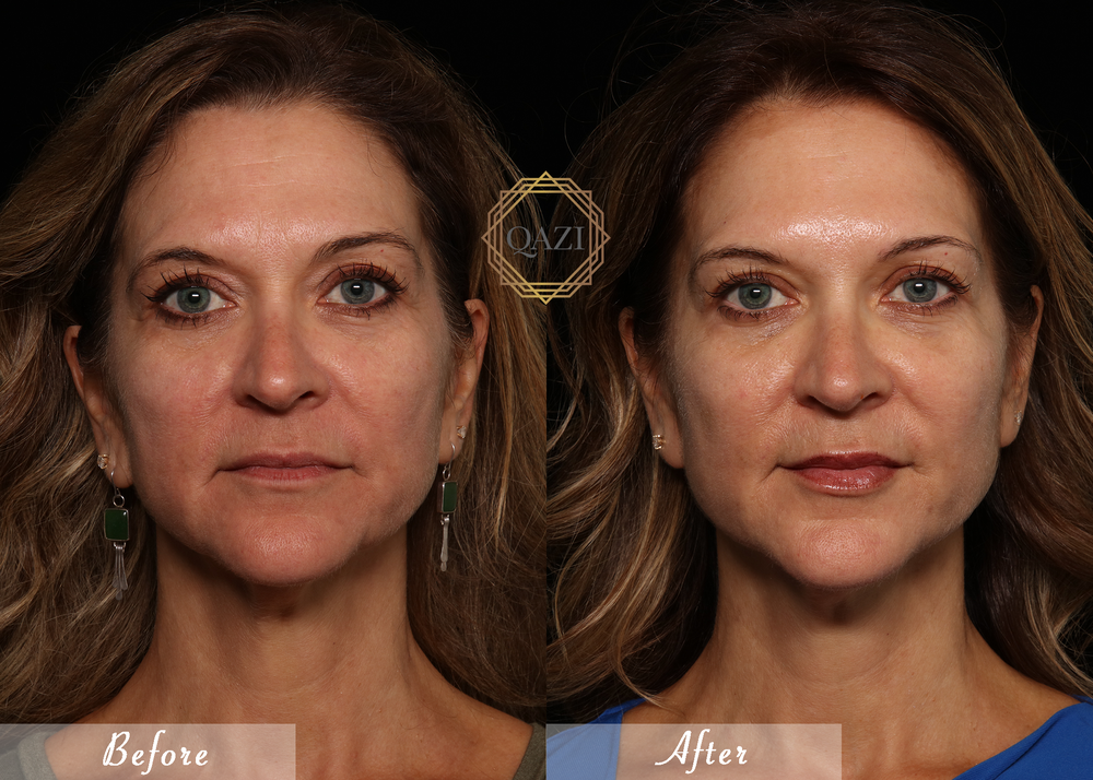 Bellafill Collagen Enhancement Filler