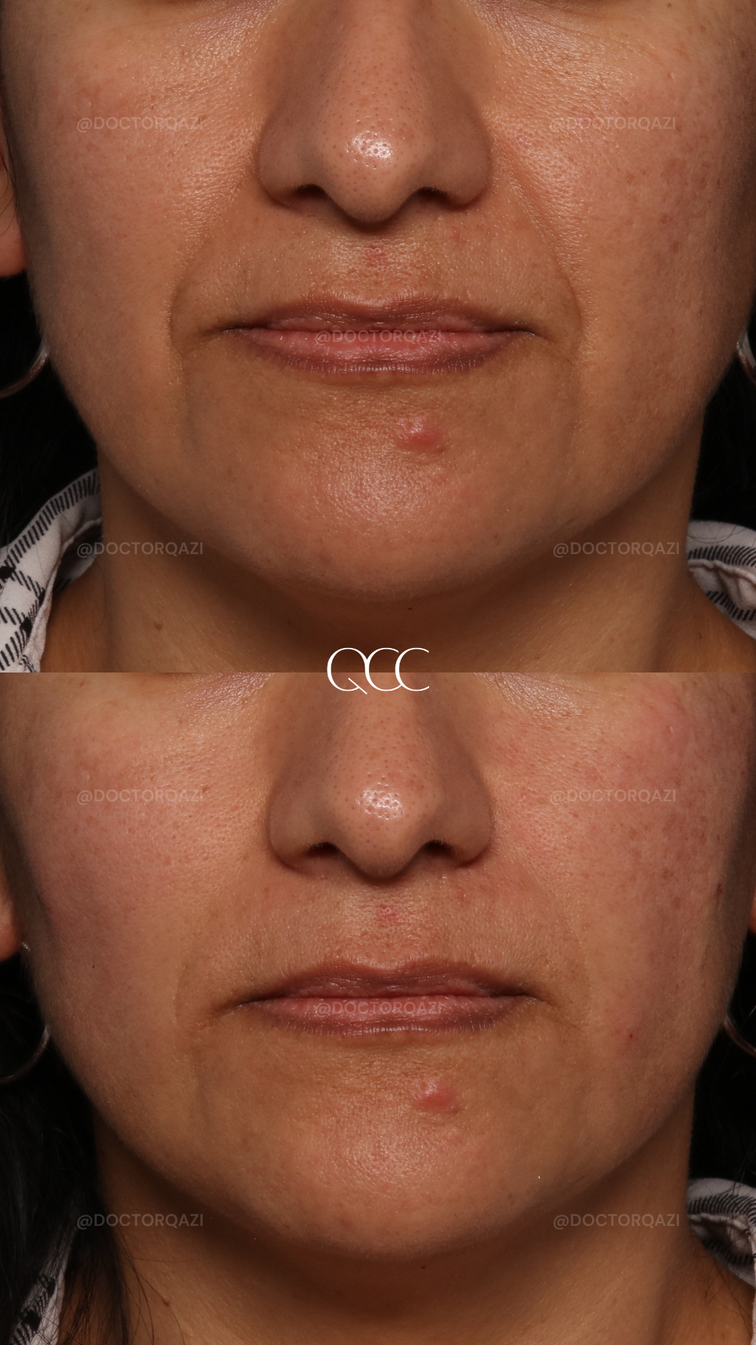 Bellafill Collagen Enhancement Filler