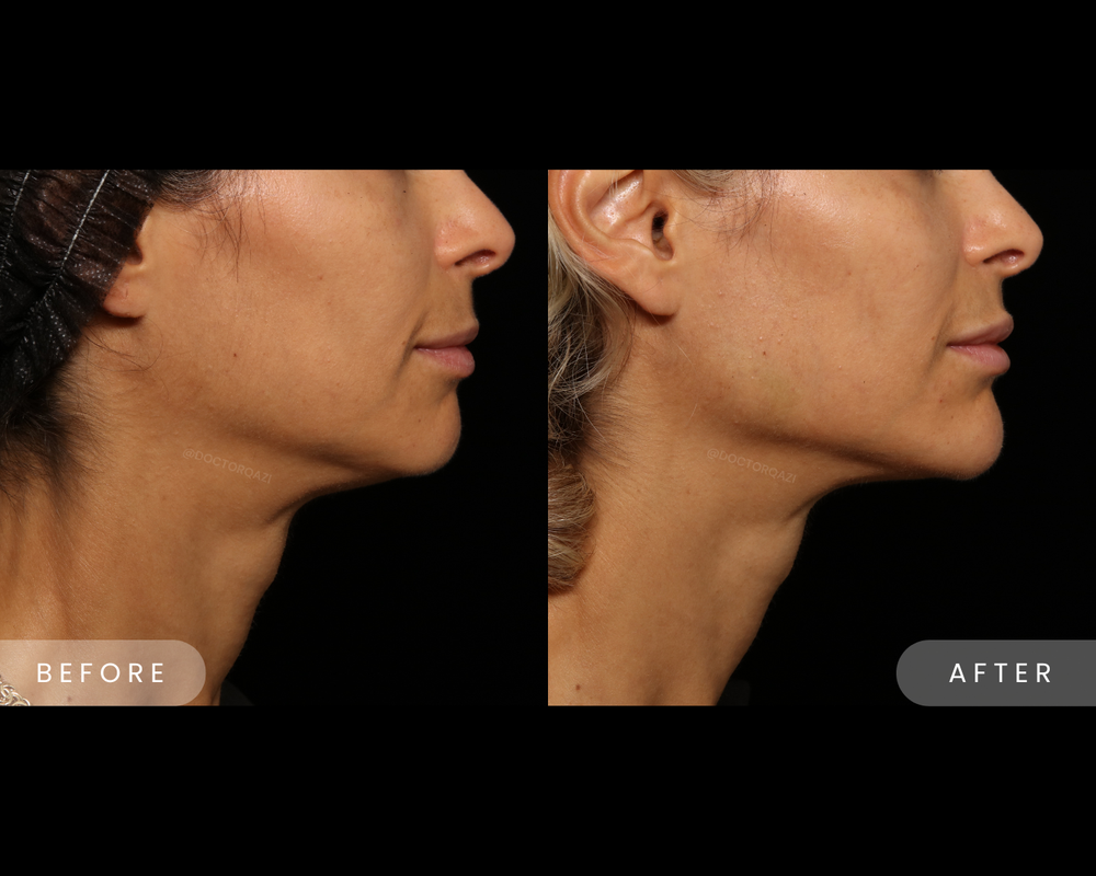 Chin Filler - Crystal Pricing