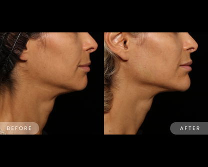 Chin Filler - Crystal Pricing