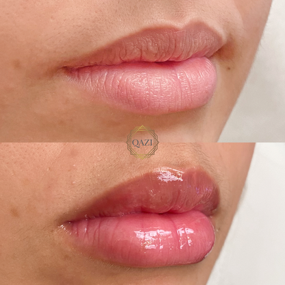 Lip Filler Treatment