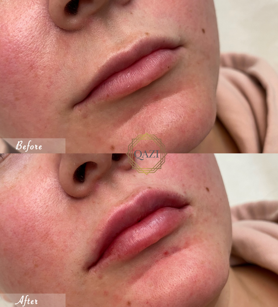 Lip Filler Treatment