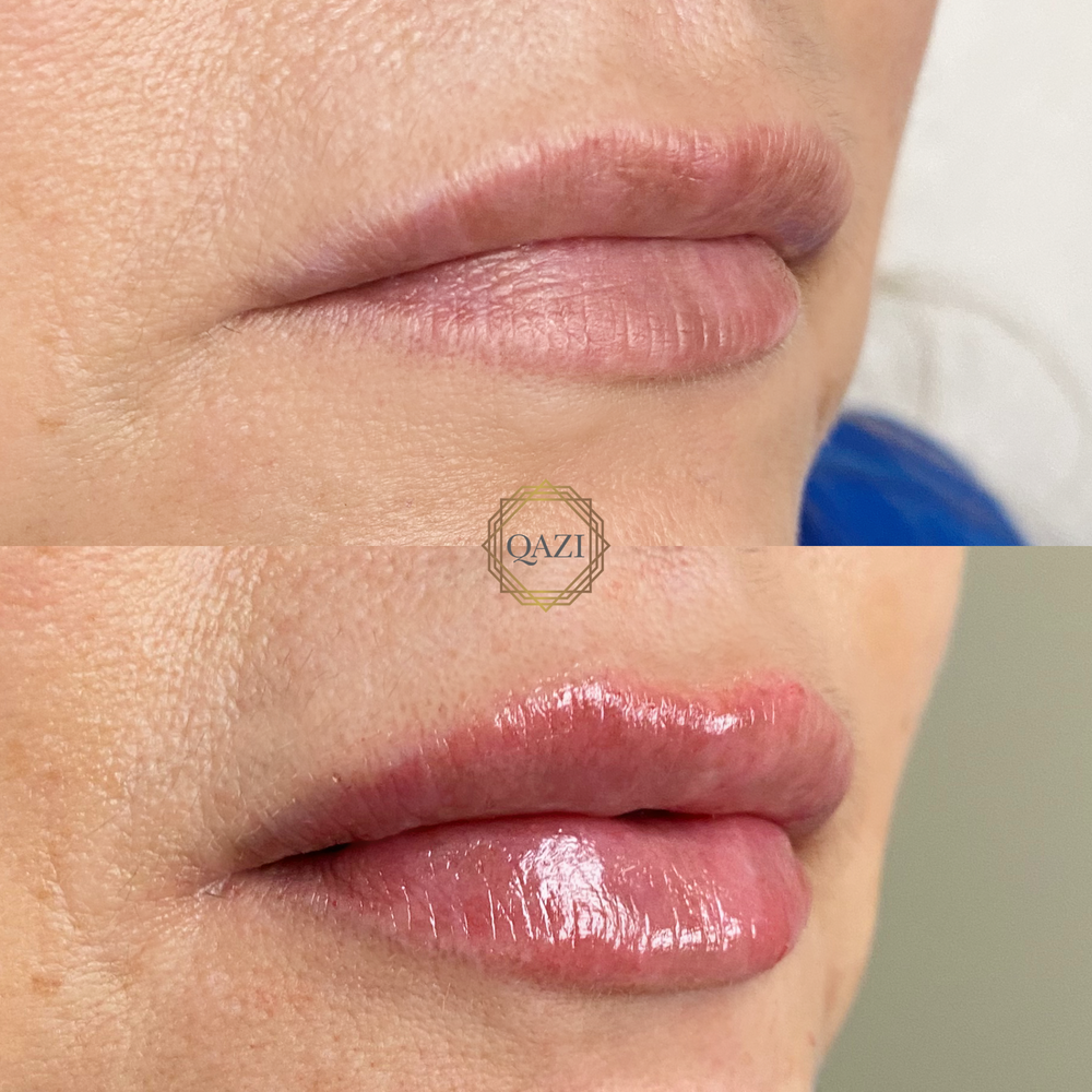 Lip Filler Treatment