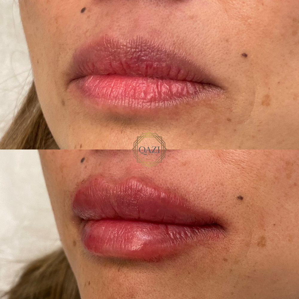 Lip Filler Treatment