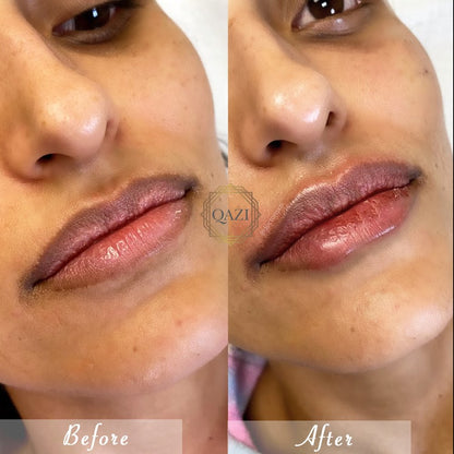 Lip Filler Treatment
