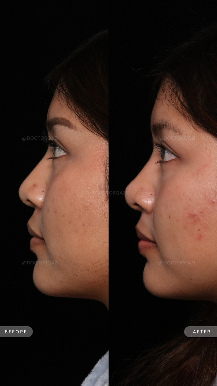 Nose Filler Profile Refinement