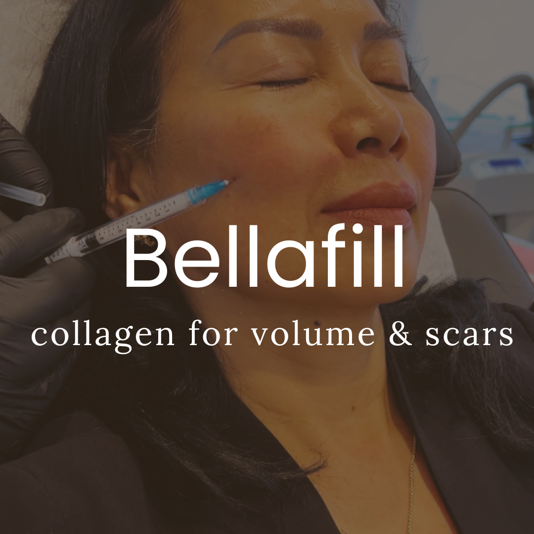 Bellafill Collagen Enhancement Filler