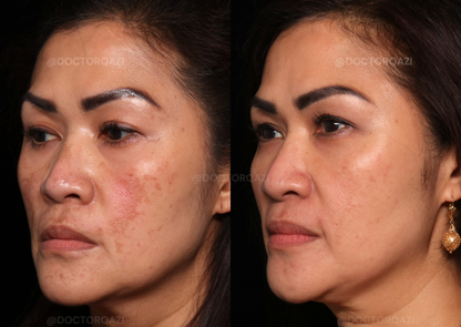 Pico Laser for Discoloration Repair