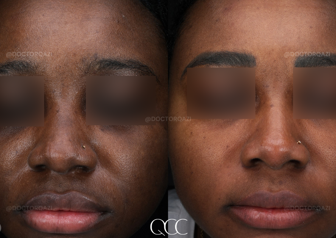 Pico Laser for Discoloration Repair
