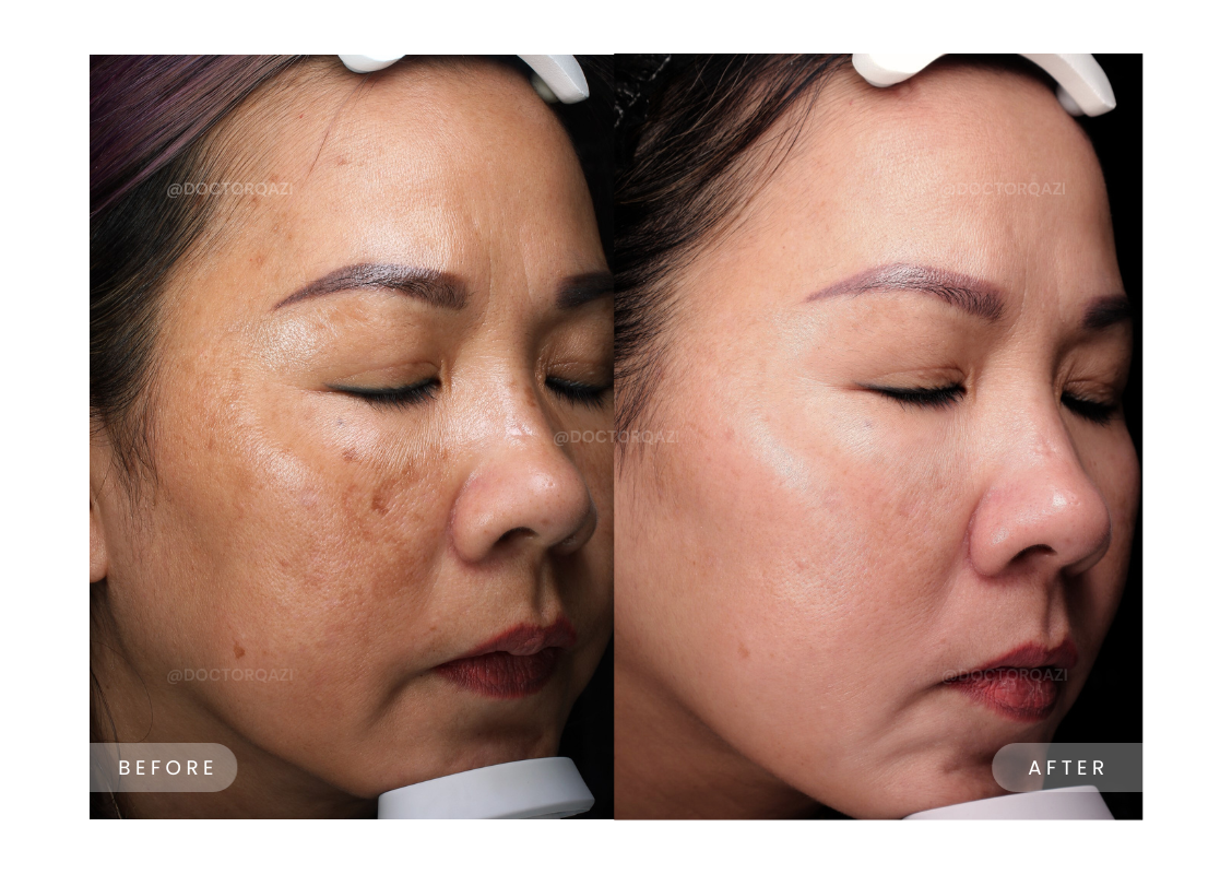 Pico Laser for Discoloration Repair