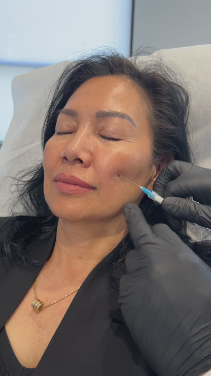 Bellafill Collagen Enhancement Filler