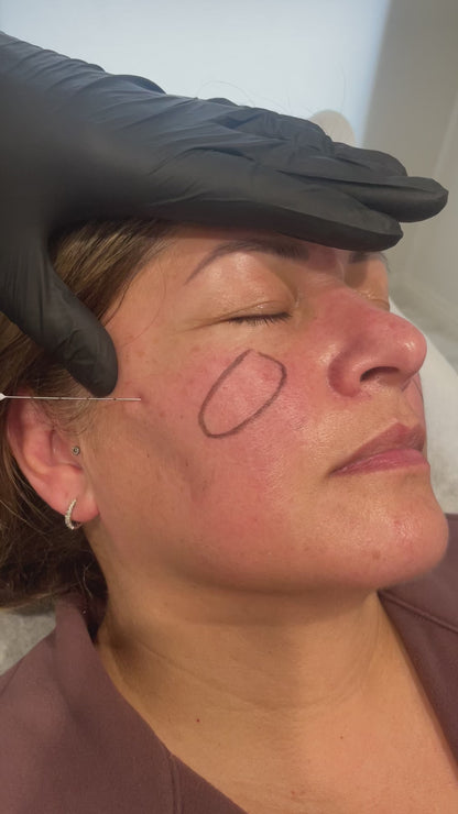 Bellafill Collagen Enhancement Filler