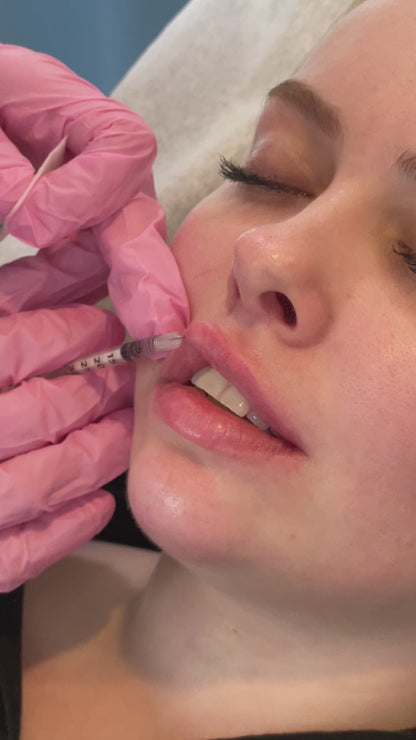 Lip Filler Treatment