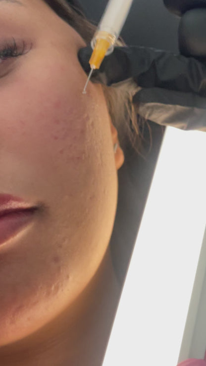 Bellafill Collagen Enhancement Filler