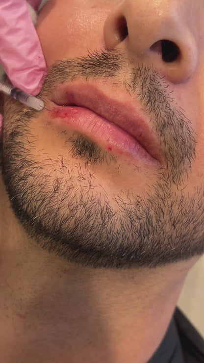 Lip Filler Treatment