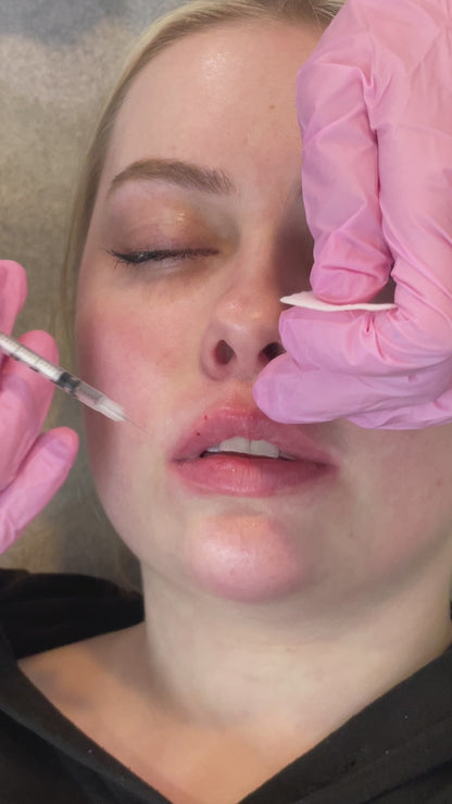 Lip Filler Treatment
