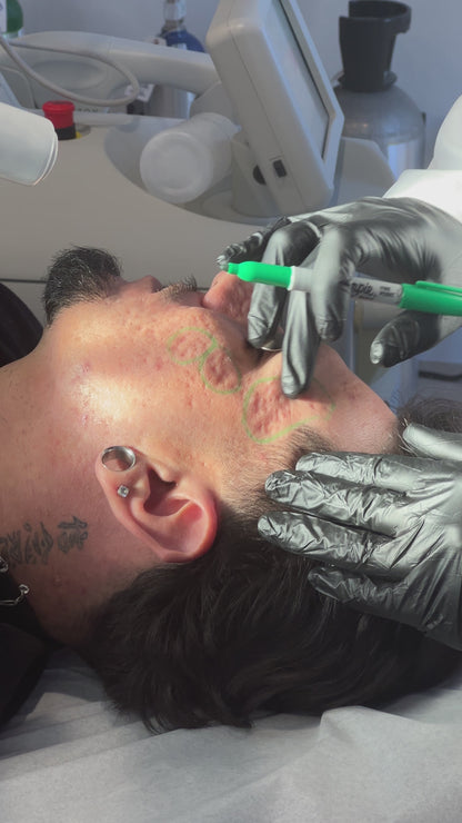 Acne Scar Consultation with Dr. Qazi (20 Minutes)