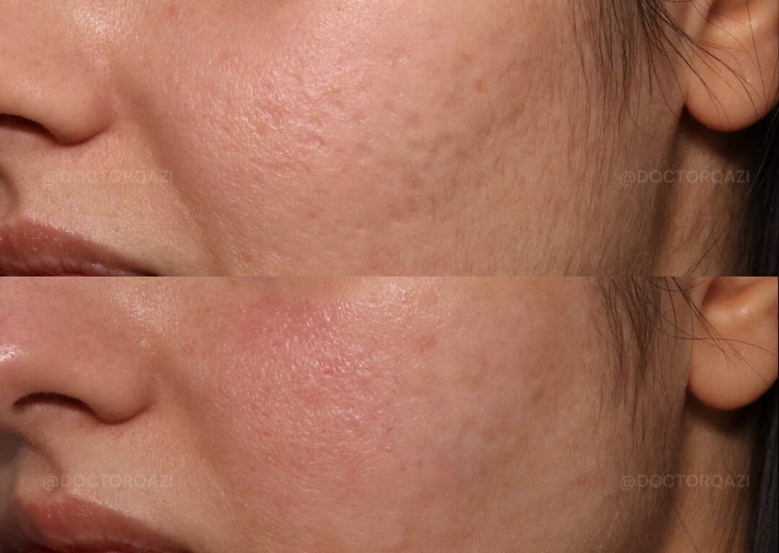 Bellafill Collagen Enhancement Filler