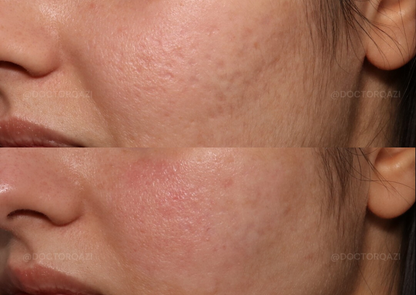 Bellafill Collagen Enhancement Filler