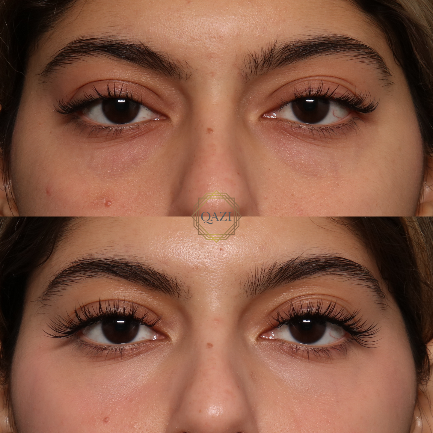 Bellafill Collagen Enhancement Filler