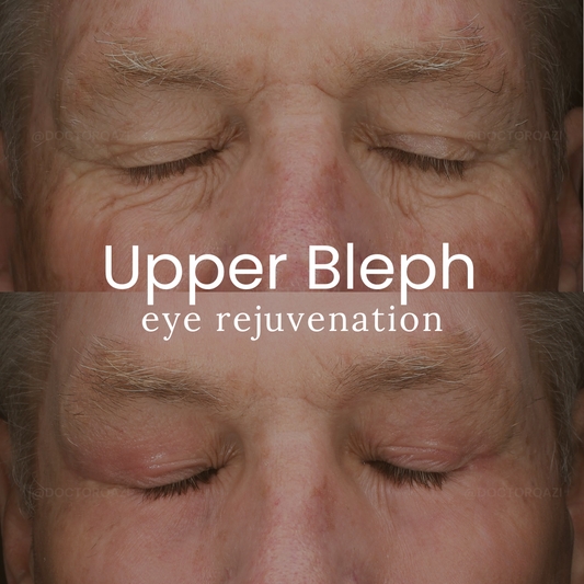 Upper Blepharoplasty Eyelid Treatment Without General Anesthesia